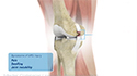 Medial Collateral Ligament Reconstruction