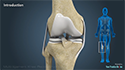 Multi-ligament Knee Reconstruction