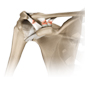 acromioclavicular dislocation