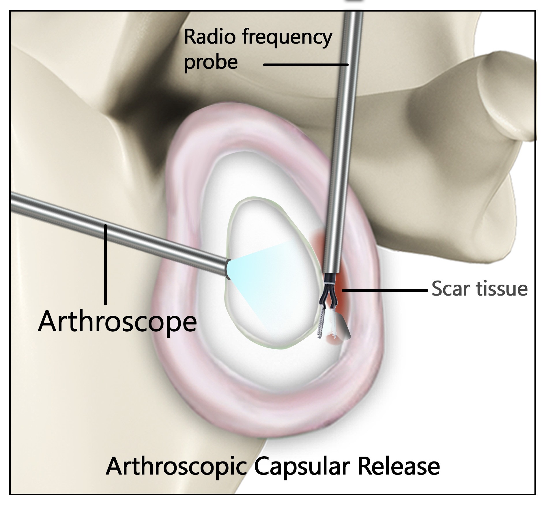 Arthroscopic capsular release