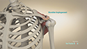 Arthroscopic Subacromial Decompression