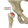 Chondral Lesions