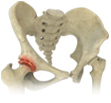 Femoro Acetabular Impingement