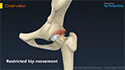 FAI – Femoro Acetabular Impingement