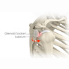 Glenohumeral Stabilization