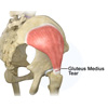 Gluteus Medius Tear