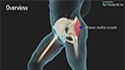 Gluteus Medius Tear