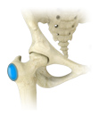 Hip Bursitis