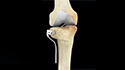 High Tibial Osteotomy