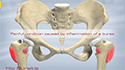 Hip Bursitis