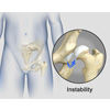 Hip Instability