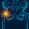 Hip Pain