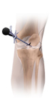 Knee Arthroscopy