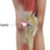 Kneecap Bursitis