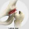 Labral Tears