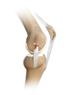 Knee Medial Collateral Ligament Injury