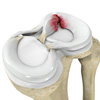 Meniscal Repairs