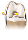 Multi-Ligament Injury