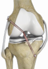 Multi-ligament Knee Reconstruction