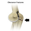 Olecranon Stress Fracture