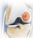 Osteochondral Allograft