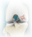 Osteochondral Autograft