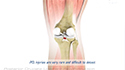 Posterior Cruciate Ligament Reconstruction