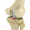 Posterior Cruciate Ligament