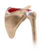 Rotator Cuff Tear